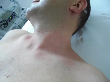 odstránenie kožných výrastkov PO