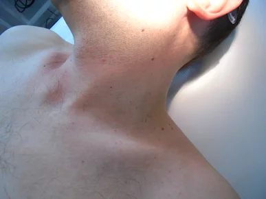 odstránenie kožných výrastkov PRED